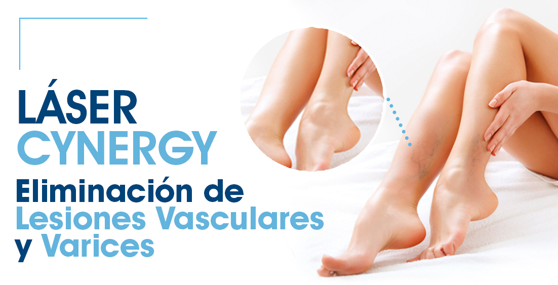 eliminación de varices cinergy
