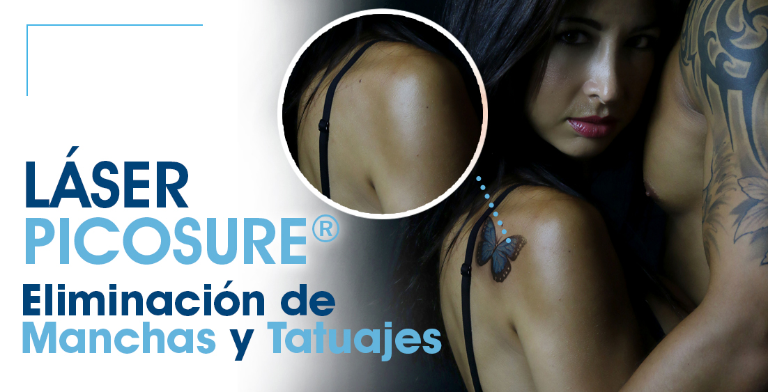 eliminación tatuajes picosure