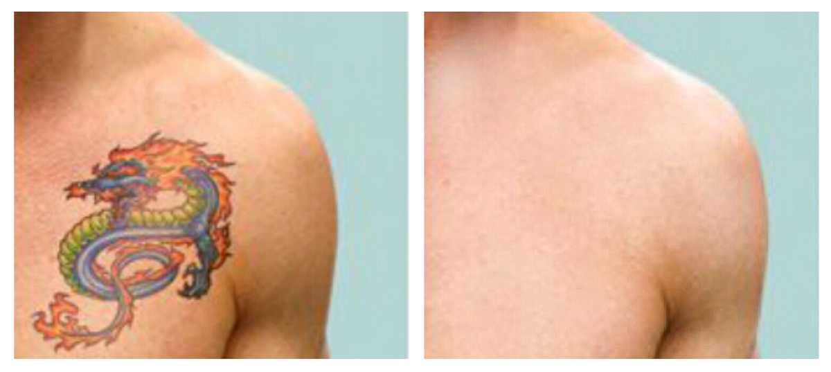 eliminació tatuatges