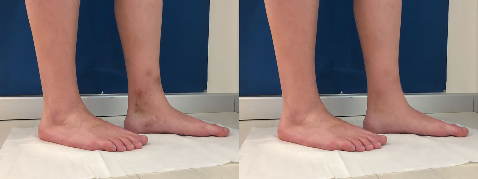 abans i despres tractament varius