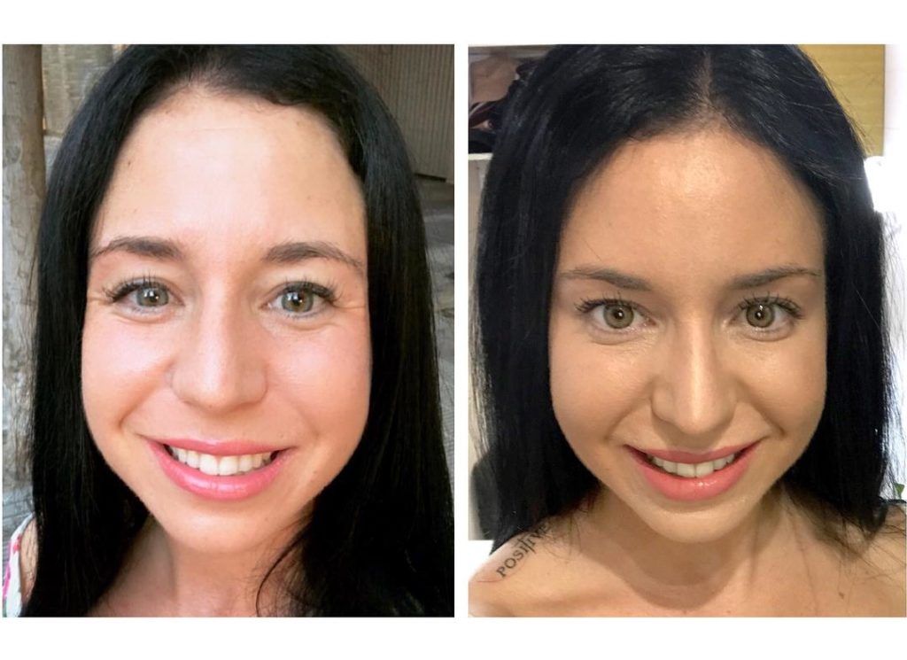 eliminació arrugues Botox