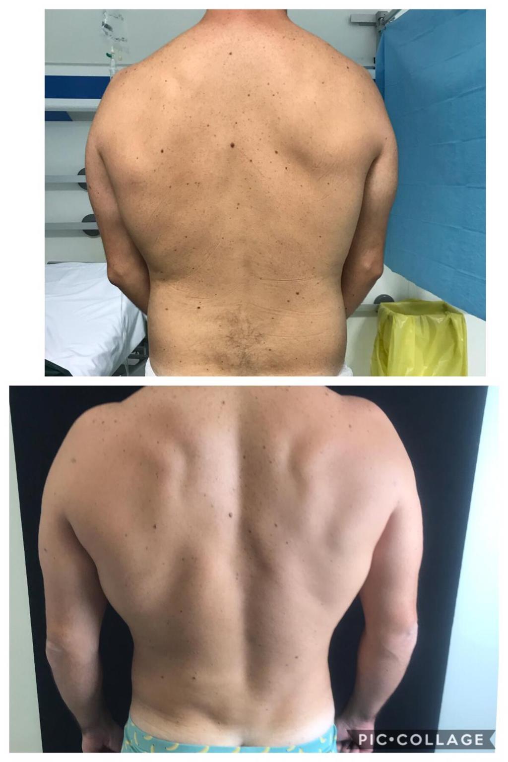 Lipo vaser esquena