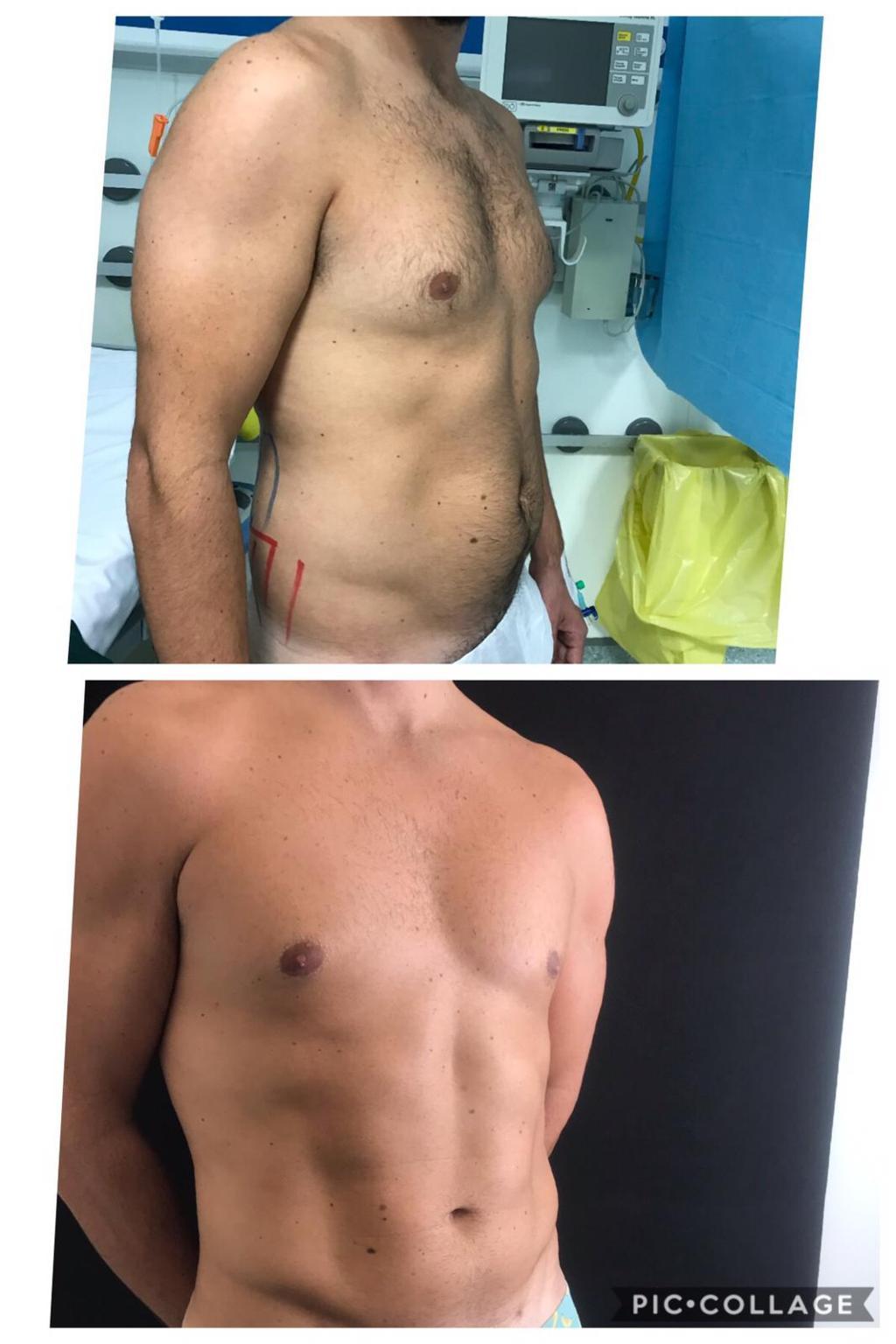 Lipo Vaser abdominals