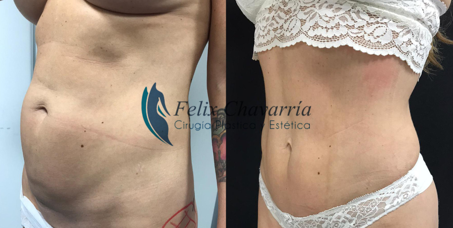 lipo vaser adominals dona