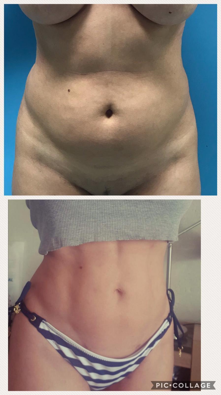lipo vaser Nexus abdominals dona