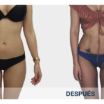 lipo vaser