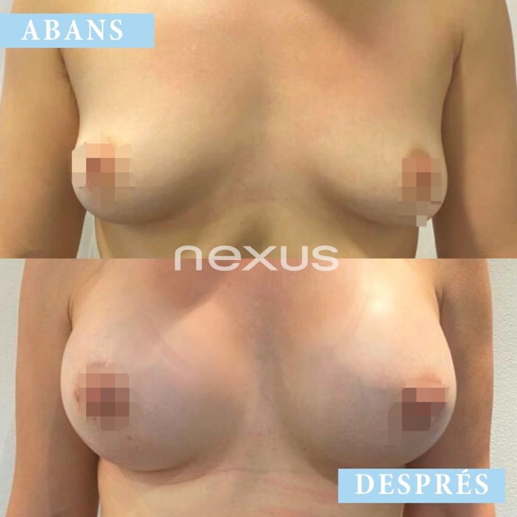 Augment de pits Clínica Nexus