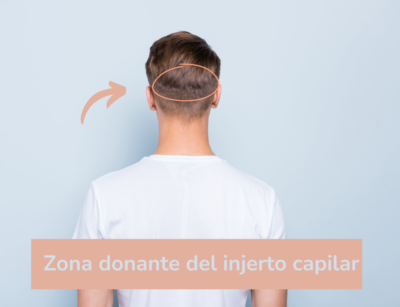 injerto capilar
