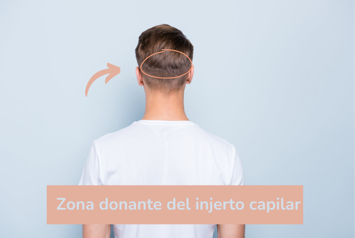 injerto capilar