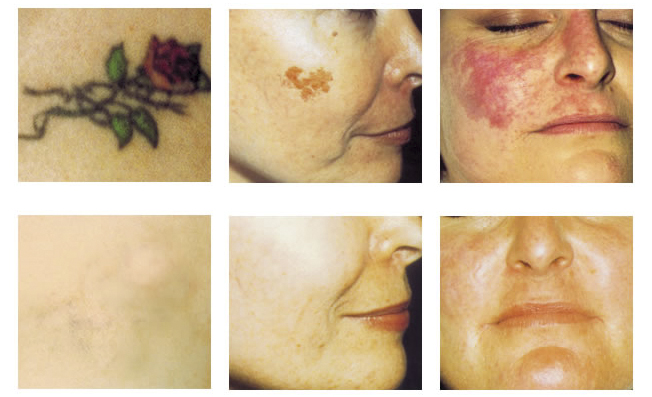 Lesions_pigmentaries