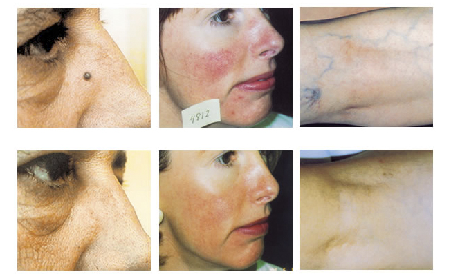 Lesions_vasculars