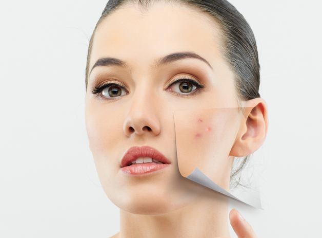 Tractaments_MedicinaEsteticaFacial_Acne
