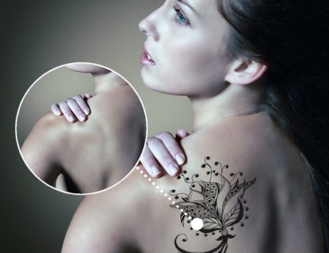 eliminació tatuatges picosure